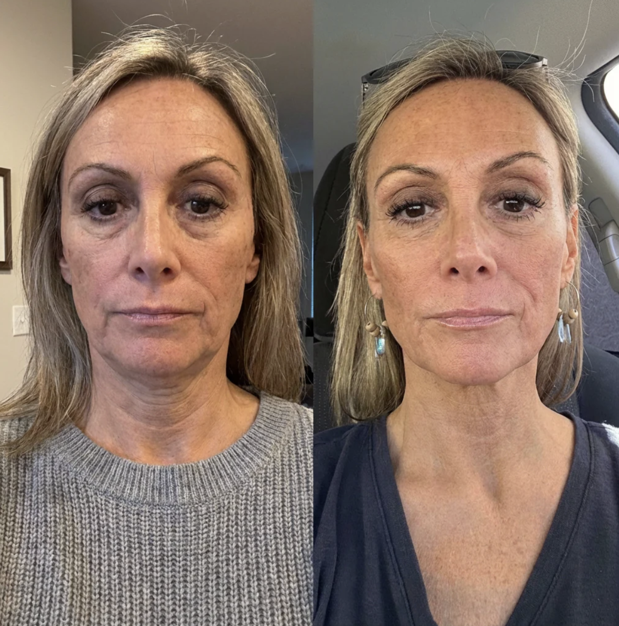 Before and after